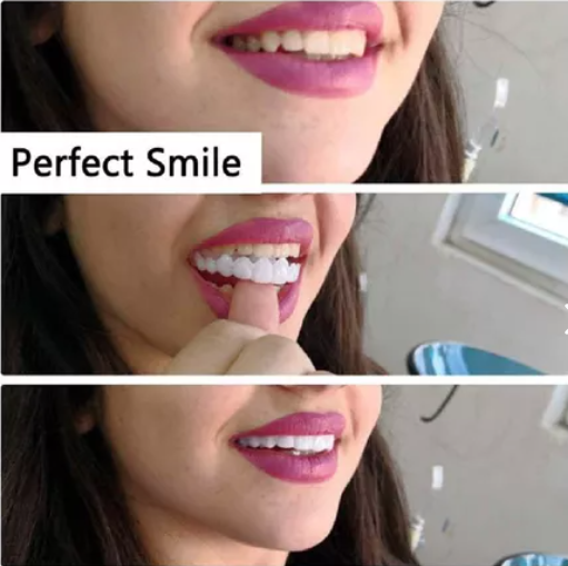 Carillas dentales - Snap On Dental®