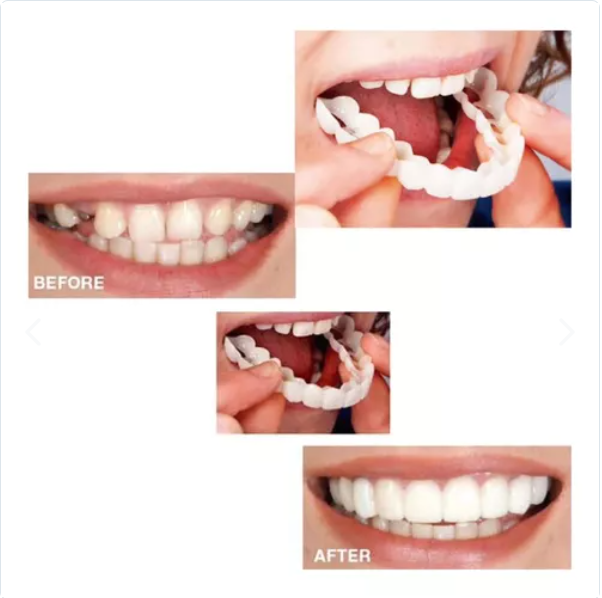 Carillas dentales - Snap On Dental®